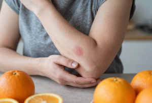 Adult checking a small bruise on their arm while holding an orange, illustrating signs of vitamin C deficiency